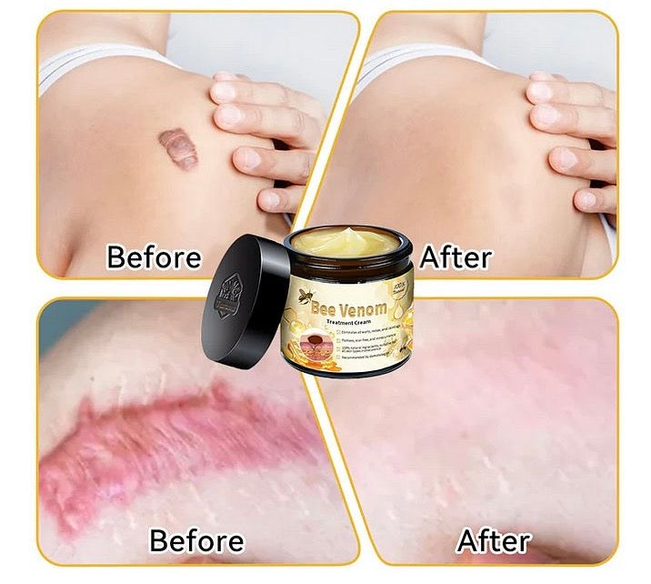 BEE VENOM ( VENENO DE ABEJA)