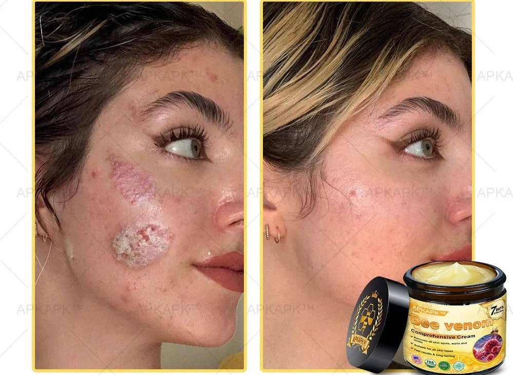 BEE VENOM ( VENENO DE ABEJA)